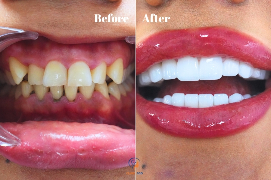 Before After