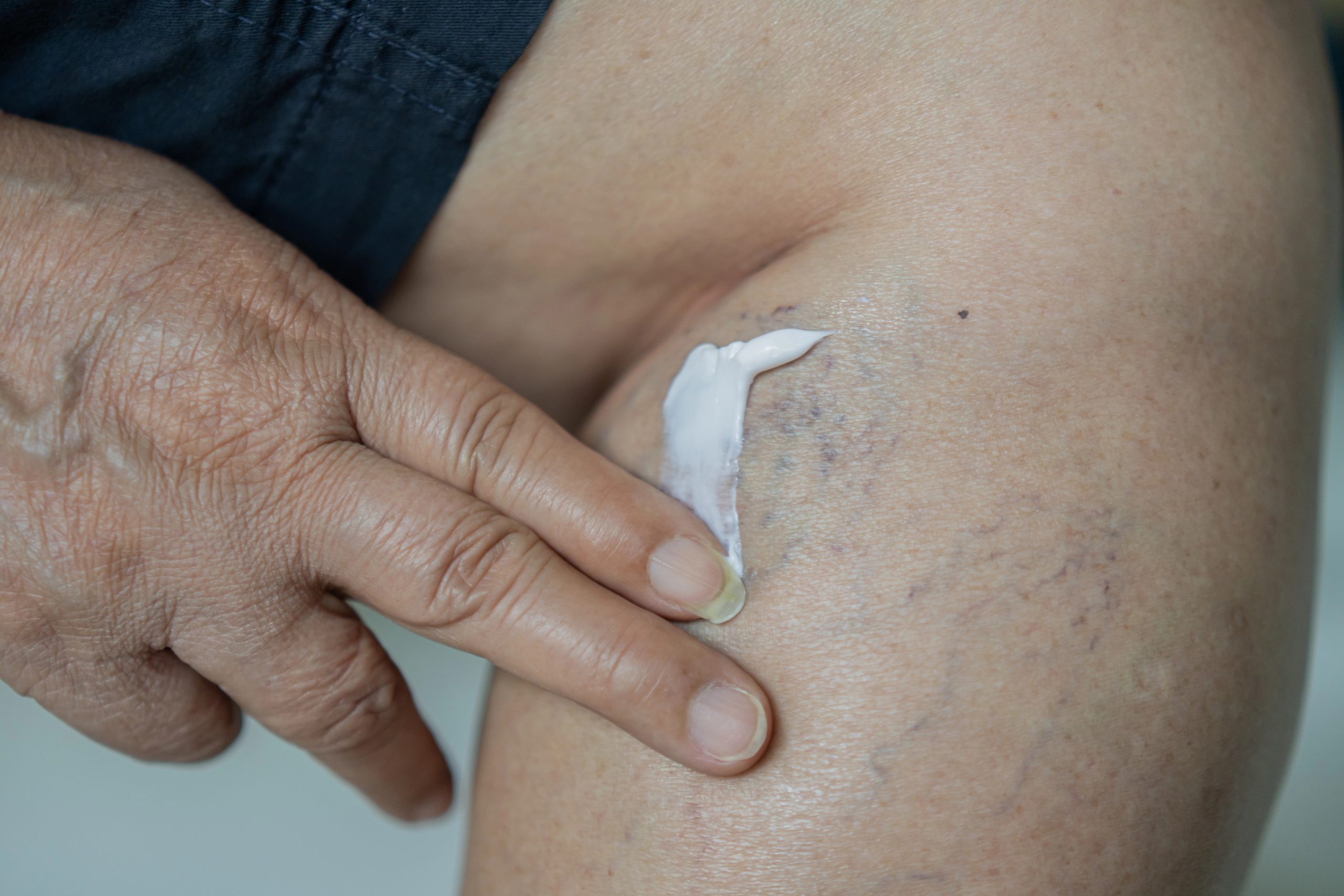 Trump’a Kronik Venöz Yetmezlik Teşhisi Kondu